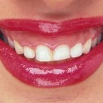 20100301_bocca_denti_bruxismo