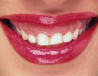 La crisi fa digrignare i denti, è boom di bruxismo La crisi fa digrignare i denti, è boom di bruxismo