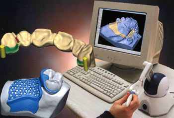 Protesi con il Cad Cam