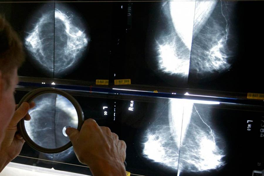 Tumore al seno, via libera al test genomico gratuito