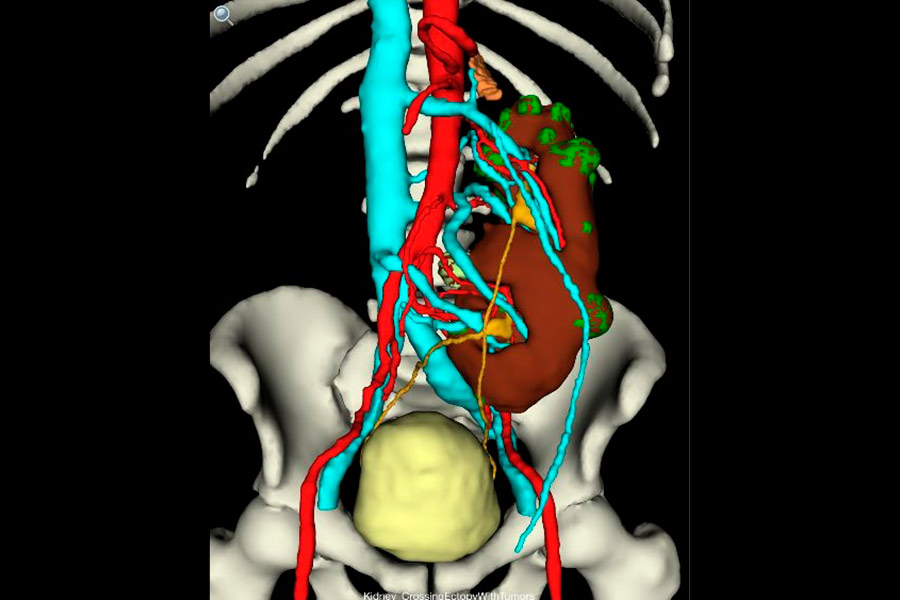 L’Urologia aretina a quota 1.000 interventi con il robot Da Vinci