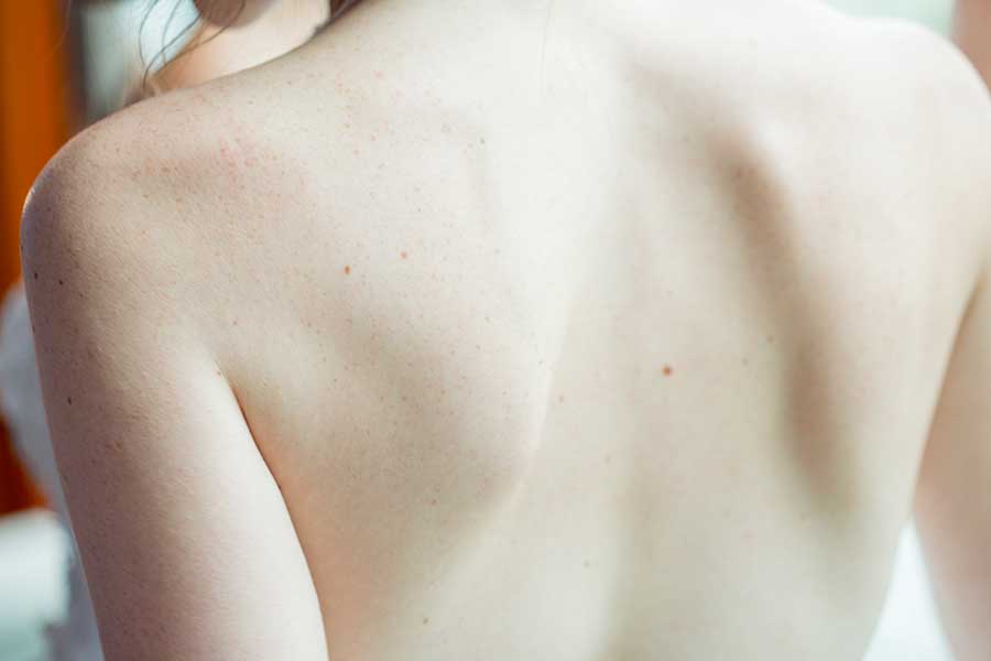 Cura della pelle: la dieta mediterranea è l’alleata perfetta contro la psoriasi