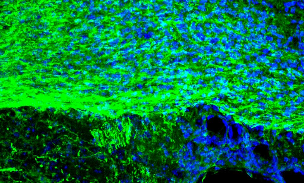 Sclerosi multipla: nuova luce sul ruolo della microglia nella riparazione della mielina